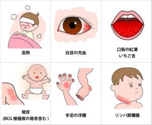 Kinh nghiệm chăm sóc bé mắc bệnh Kawasaki ở Nhật