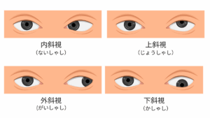 Nhật cảnh báo trẻ em bị lác mắt do xem điện thoại quá nhiều